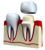 Протезирование зубов в Открытой стоматологии