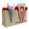 Имплантация зубов в Открытой стоматологии