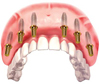 Комплексная имплантация зубов в Открытой стоматологии